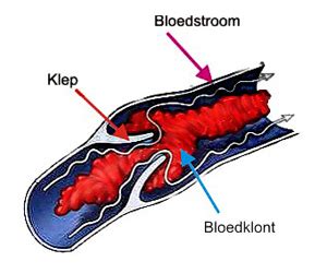 Bij trombose raakt een bloedvat verstopt door een bloedstolsel. Nieuws: Trombose- doodsoorzaak-nr-1, Amstelveen