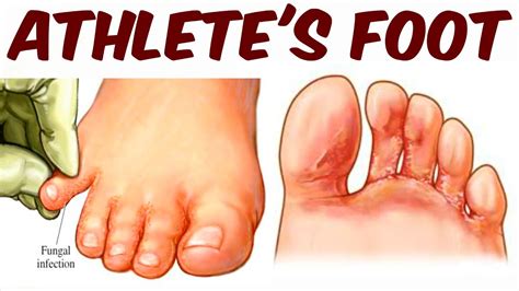 Athlete S Foot A Tinea Pedis Infection Youtube