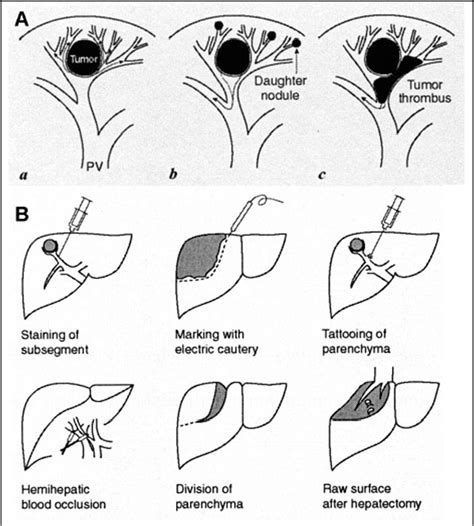 Figure 3 From Surgical Management Of Hepatocellular Carcinoma Liver