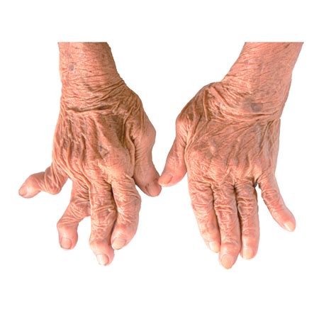 Living With Rheumatoid Arthritis