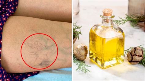 Tips Get Rid Of Varicose Veins With Essential Oils Youtube