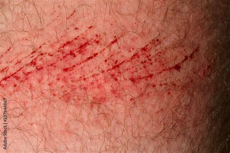 Scratch Skin Wound Or Cut On The Skin Red Blood Hairy Part Of A Man