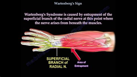 Entrapment Of Radial Nerve Wartenberg S Syndrome Everything You Need