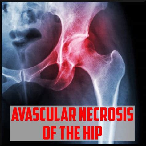 Avascular Necrosis Of The Femoral Head Diagnosis Sports Medicine Review