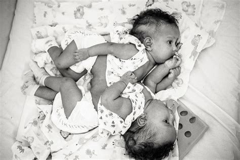 Photographer Captures Amazing Pictures Of Conjoined Twins Before And