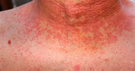 What Are The Symptoms Of Scarlet Fever What Is It And Is It Contagious