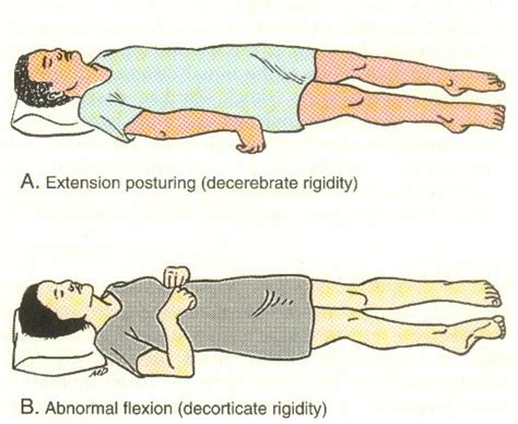 Hypertonicity Vs Spasticity Physiopedia Universal Access To