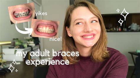 Check spelling or type a new query. My Adult Braces Experience // deep overbite, bite plate ...