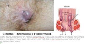 Hemorrhoids are the most common diseases of the rectum. C Thrombosed Hemorrhoids - maternity photos