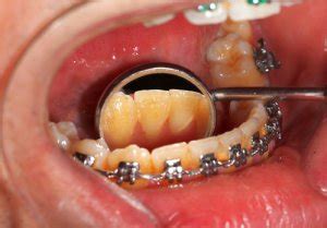 Teeth whitening with braces is one of the main concerns of people wearing braces and carring about how beautiful their smile is. Gingivitis and Gum Disease: What to Do If You Have ...