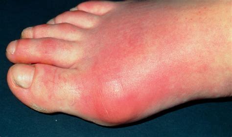 Arthritis Symptoms Include Swollen Toes For This Painful Condition
