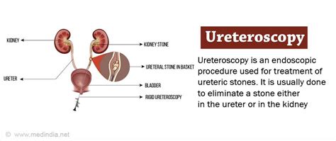 Ureteroscopy Overview