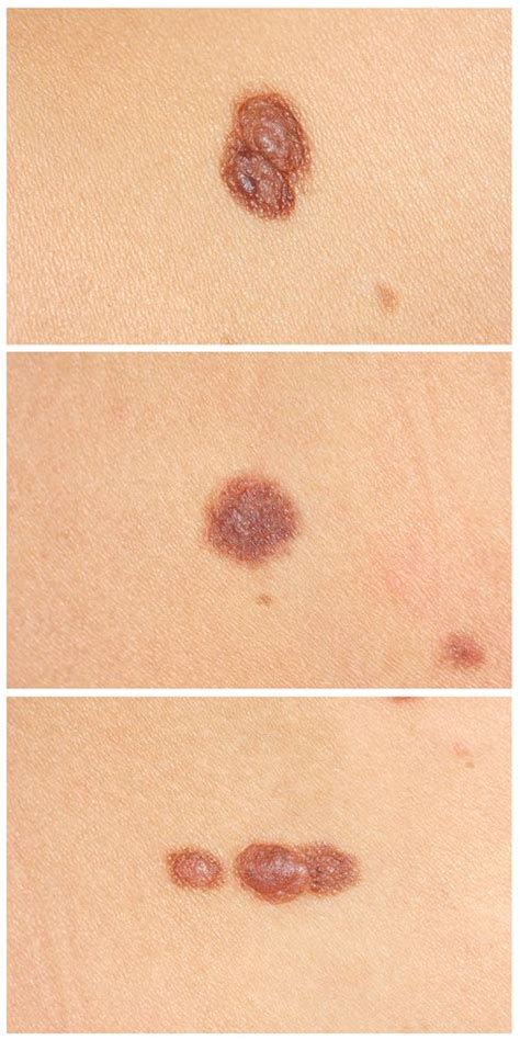 Mole Vs Freckle How To Spot The Difference Beverly Hills Md My Xxx Hot Girl