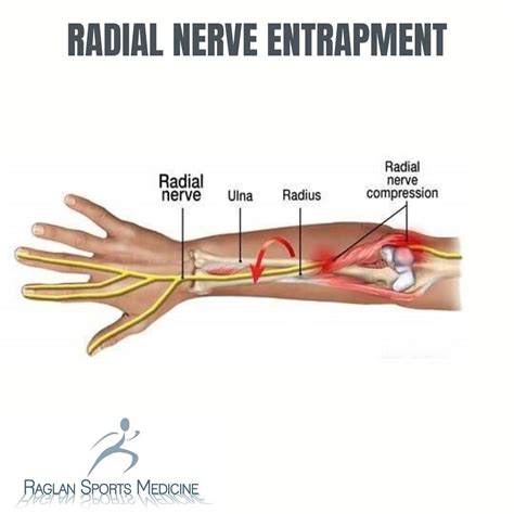 The Radial Nerve Contains Nerve Fibers From Spinal Routes C5 T1 And