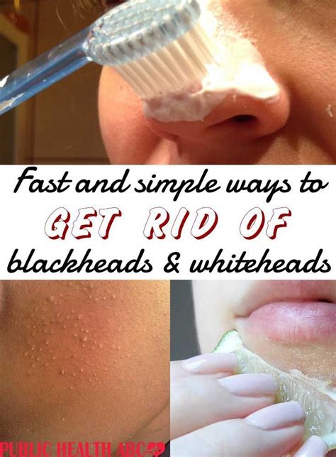 How To Get Rid Of Whiteheads On Face Whiteheadsvsblackheads