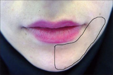 Region Of The Left Lower Lip Affected By Paresthesia