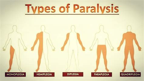 Medico Learning On Instagram “different Types Of Paralysis Follow
