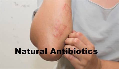 10 Natural Antibiotics For Skin Infections Recentfacts