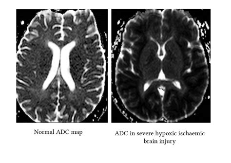 Radiological Findings In Hypoxic Ischaemic Encephalopathy Deranged