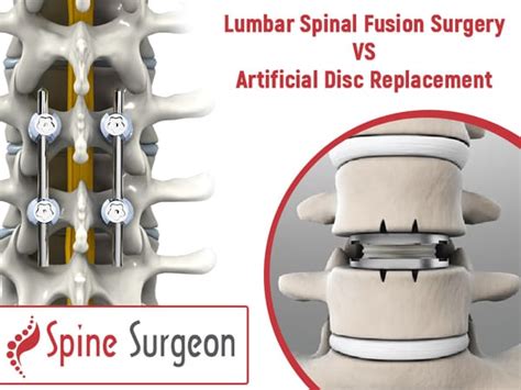 Lumbar Spinal Fusion Surgery