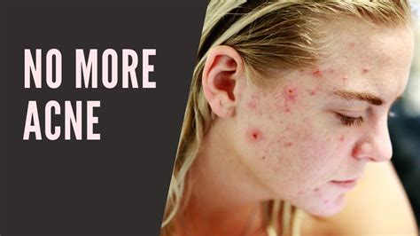 Natural Treatments For Acne Youtube