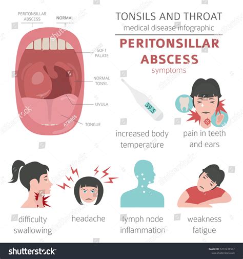 Tonsils Throat Diseases Peritonsillar Abscess Symptoms Stock Vector