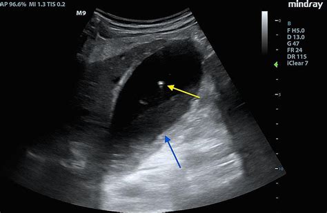 Gallbladder Ultrasound Cholecystitis