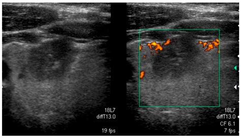 Follicular Thyroid Cancer Ultrasound