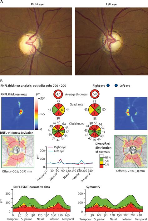 Diagnosis And Clinical Features Of Common Optic Neuropathies The