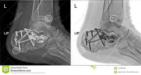 Broken Heel Xray Fixed With Screws And Plate Foot Pain At Doctor