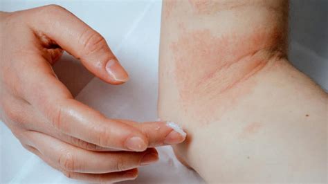 Eczema May Stem From Poorly Regulated Sex Hormones
