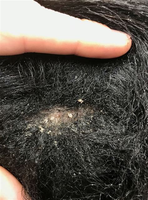 Green suggests a little to those with fine hair it might sound crazy, but that extra moisture might be just what your scalp the fix: Afro Scalp Cleansing - Remove the itchy dry flaky scalp