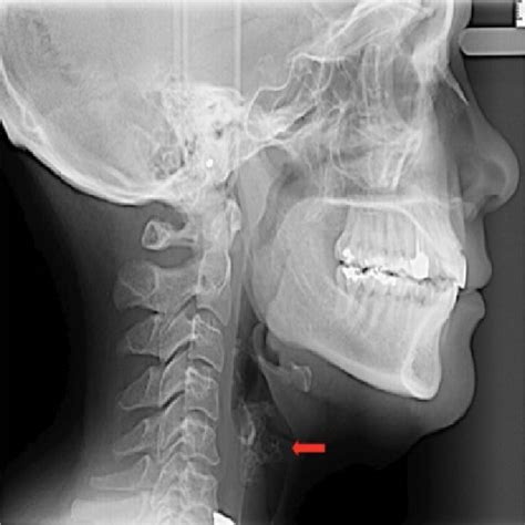 The Calcification Can Be Observed Near The Laryngeal Cartilages