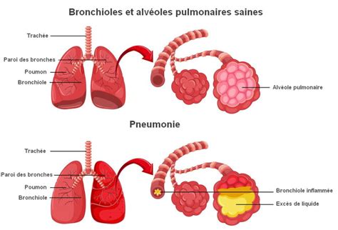 Complications Et Traitement De La Pneumonie Salem Diagnostics