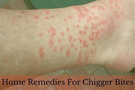 Chigger bites usually get better on their own. 23 Home Remedies To Get Rid Of Chigger Bites At Home