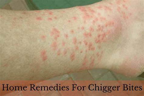 Chigger bites can happen anywhere on your body, but they often show up in clusters around the waist or lower legs. 23 Home Remedies To Get Rid Of Chigger Bites At Home