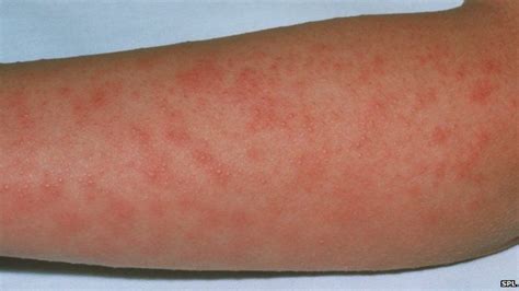 Resurgence Of Scarlet Fever Reaches 24 Year High Bbc News