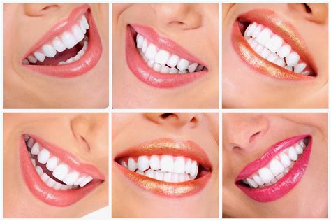 New Smile Dental Brighten Your Smile With Teeth Whitening From Dr Lopez