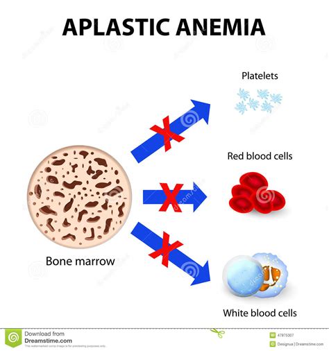 Aplastic anemia stock vector. Illustration of medical ...