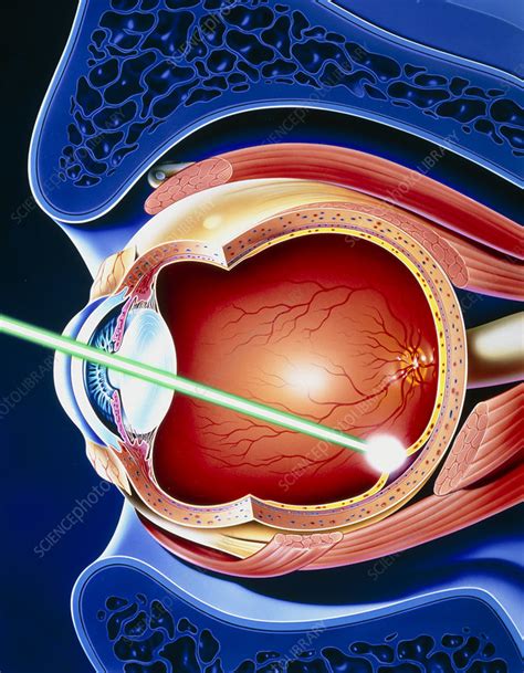 Artwork Of Laser Surgery On Detached Retina Stock Image M5700075 Science Photo Library