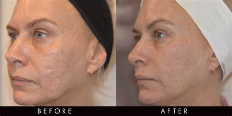 Before And After Fractional Radiofrequency Vamp Newcastle