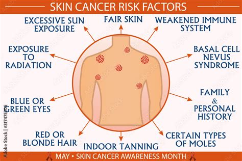 Skin Cancer Risk Factor Infographic Vector Illustration Health And