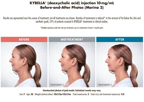 Kybella Double Chin Treatment Before And After Photos