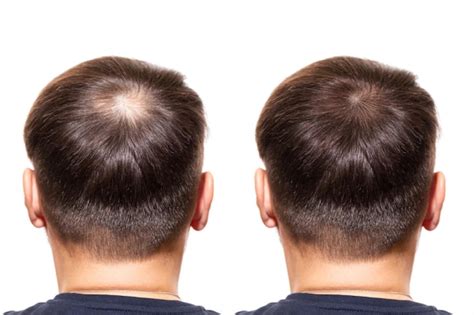 Premium Photo Hair Loss Care Concept Transplantation Hair Men View