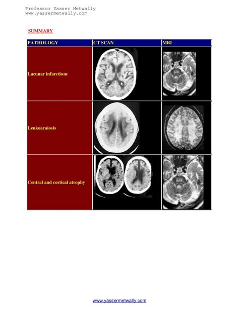 Radiological Pathology Of Ischemic Microvascular Brain Diseasean Upd