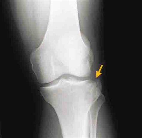 Lateral Tibial Plateau Fracture Journal Of Orthopaedic And Sports