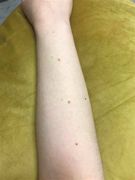 The Moles On My Arm Are Lined Up Rmildlyinteresting