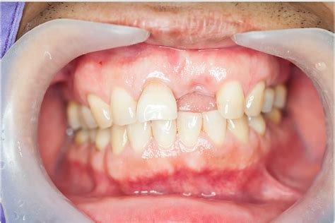 Is A Gum Graft Procedure Painful
