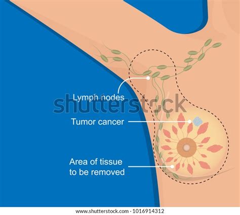 Mastectomy Breast Cancer Lymph Node Dissection Stock Vector Royalty