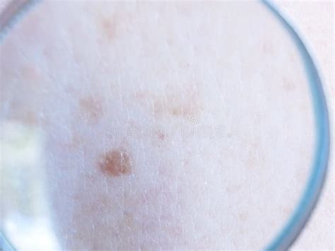 Dermatologist Examines A Birthmark Of Patient Checking Benign Moles